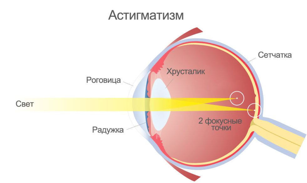 Как фокусируется изображение рассматриваемого предмета при астигматизме