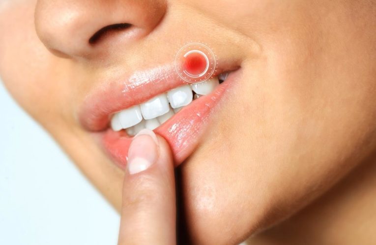 Впервые исследовано происхождение вируса герпеса на губах